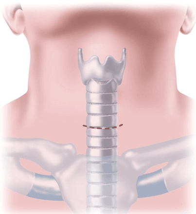 Mediastinoscopy Surgical Procedure