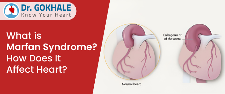 What is Marfan Syndrome? How Does It Affect Heart? | Dr Gokhale