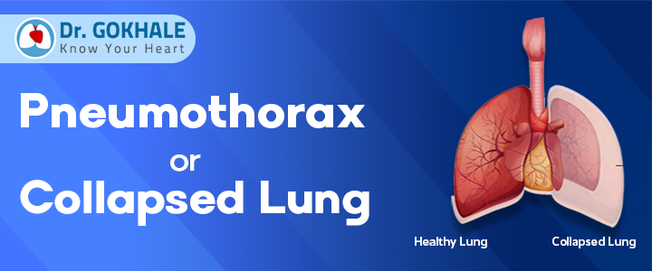 What is Pneumothorax or Collapsed Lung? | Dr Gokhale