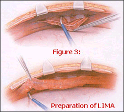 Preparation of LIMA