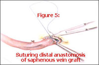 suturing distal anastomosis of saphenous is vein graft