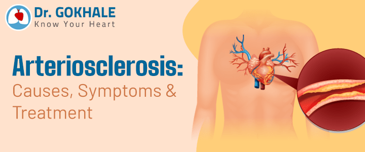 Arteriosclerosis: Causes, Symptoms & Treatment