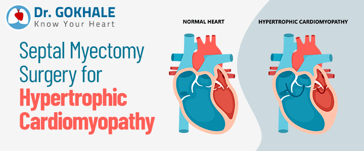 Septal Myectomy Surgery for Hypertrophic Cardiomyopathy