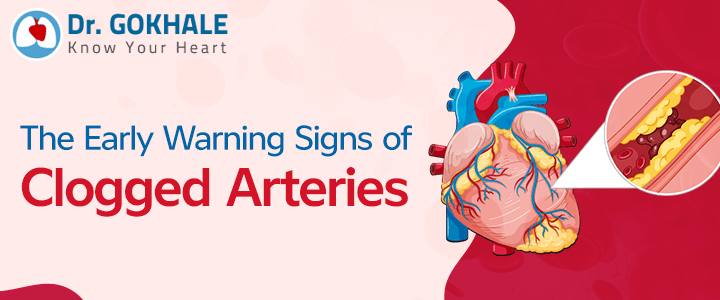 The Early Warning Signs of Clogged Arteries