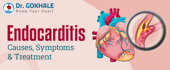 Endocarditis: Causes, Symptoms and Treatment