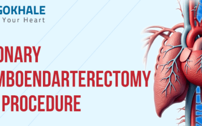 Pulmonary Thromboendarterectomy (PTE) Procedure