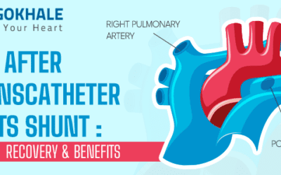 Life After Transcatheter Potts Shunt: Recovery and Benefits