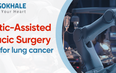 Robotic-Assisted Thoracic Surgery (RATS) For Lung Cancer